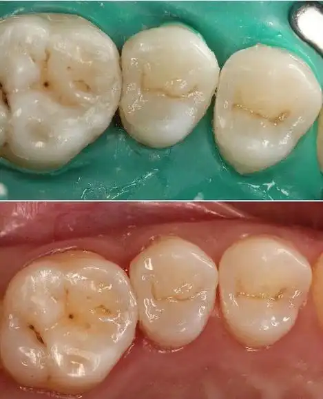 在临床上很多患者朋友去补牙,去的时候没有不舒服,可补完后却出现了