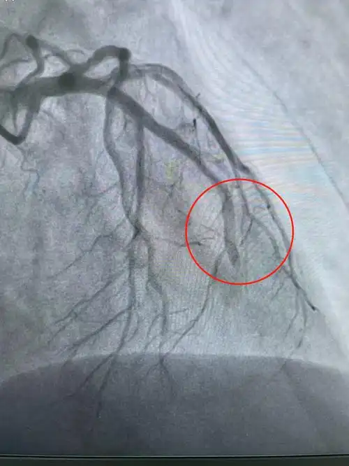 术前患者前降支血管完全闭塞