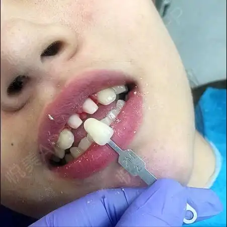 我是一名学生,小时候跟小伙伴一起玩耍时,门牙掉了很.烤瓷牙_悦美整形