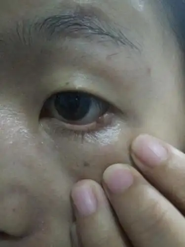 下眼睑长个小肉肉,有十年了,之前不认真看都看不出来,最近感觉变大了