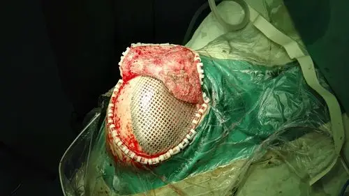 三维钛网颅骨修补成型术 - 好大夫在线