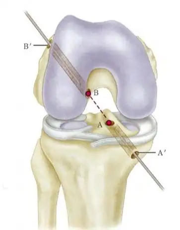 主任说:前交叉韧带重建,这 5 个选择术前必需做好!