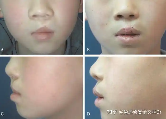 牙槽畸形主要指牙槽裂,这往往发生于完全性唇裂,一般可以在10-12岁