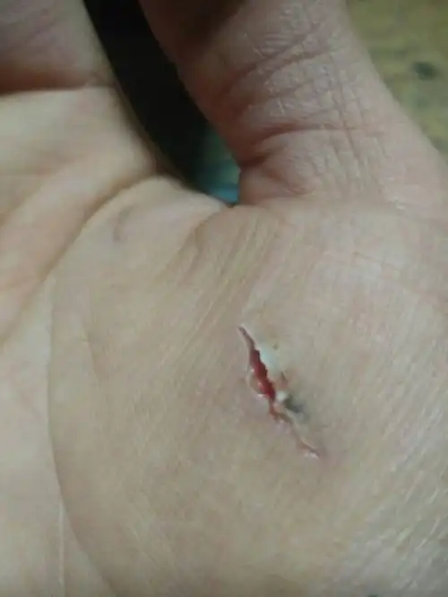 手心不小心被新用的美工刀片划破手了,伤口大概有三厘米长度, .