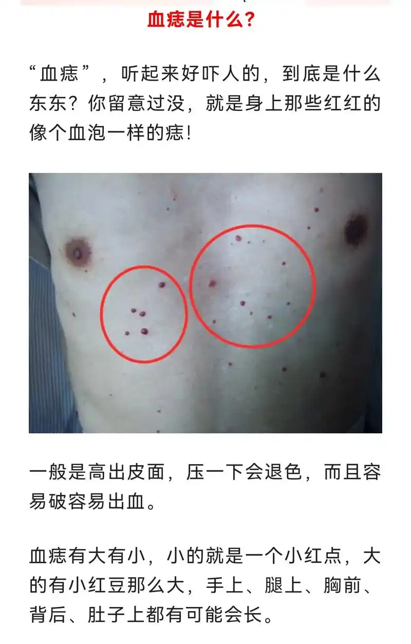 看看您长得有这个吗?红痣 - 抖音