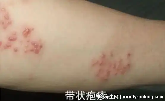 带状疱疹图片初期症状带状疱疹刚出来时的照片长密集水疱