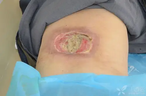 糖尿病患者背部严重溃烂,就诊多家医院治疗无效,而转入我院救治 [病例