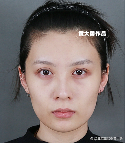 24岁小姐姐下颌角术后4个月 方圆脸秒变瓜子脸