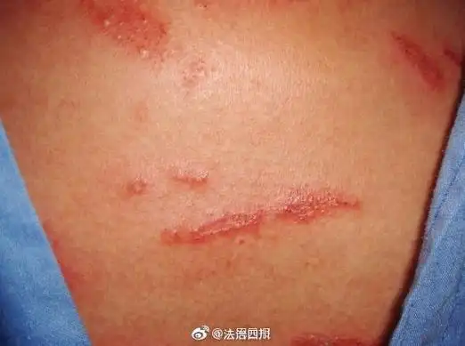 【隐翅虫这种虫子千万别拍!毒液可能致皮肤溃烂!