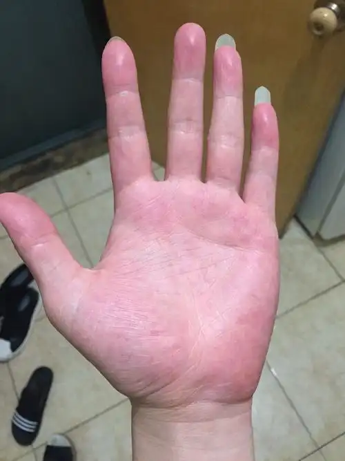 有没有学医或者懂的中医方面的朋友帮我看一下,我这手掌红,发热是什么