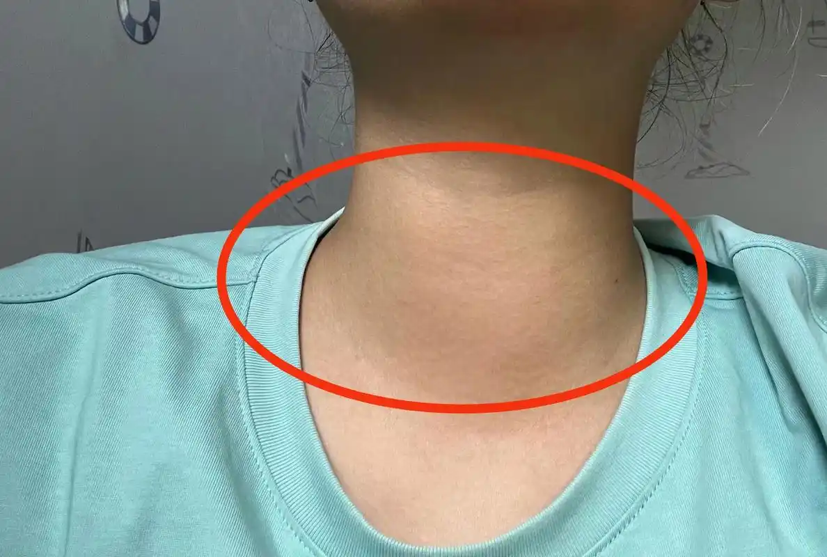 甲亢好了 粗脖子,发黄,心慌不见了