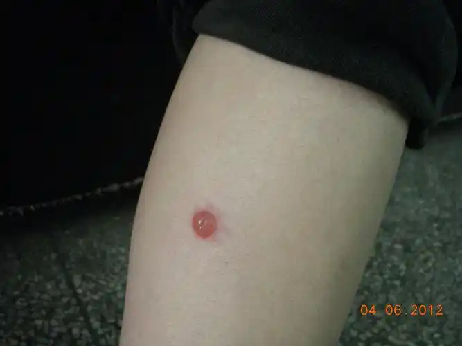 典型丘疹性荨麻疹一例