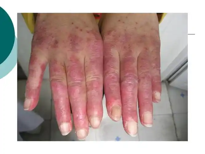 系统性红斑狼疮病人护理详解ppt