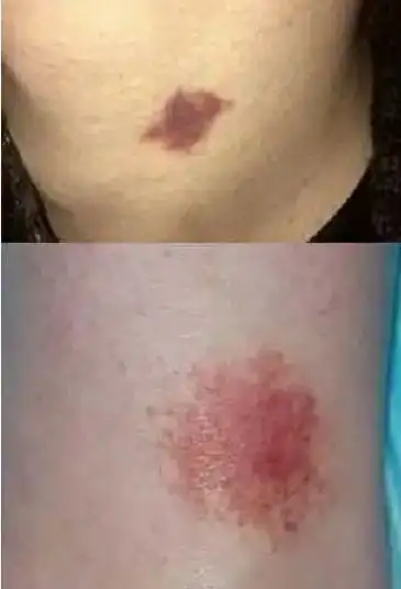 男子脖子上突现草莓印3年感情差点凉凉去医院才找到真相