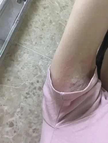 腋下长了很大块红色呈片状的东西,痒,是过敏还是什么,求帮助