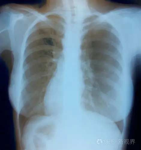健康女人胸部 x 射线图像