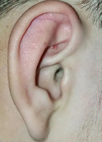 我耳朵里这是长得什么?感觉摸着有点疼.