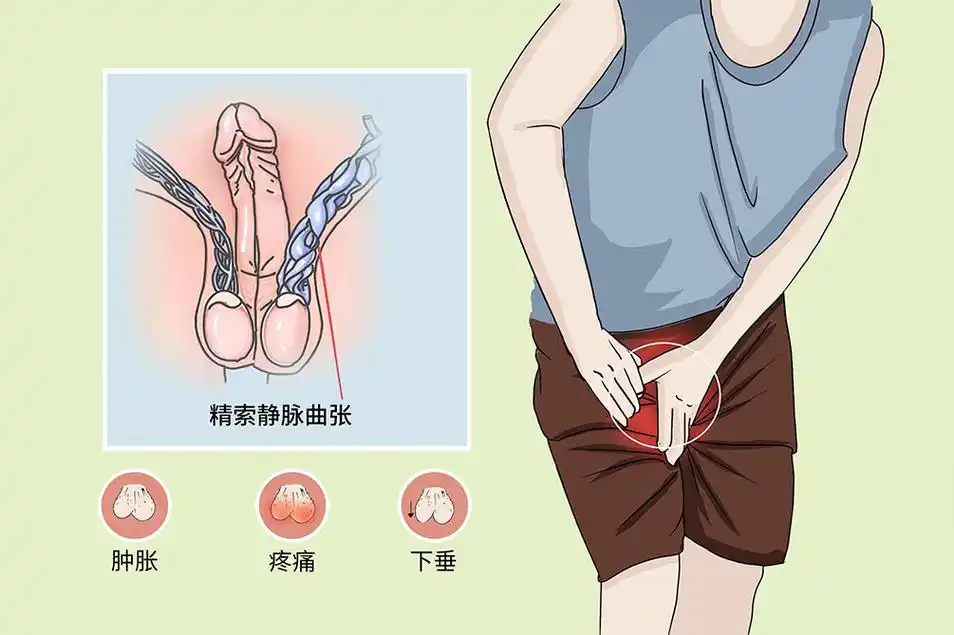 精索静脉曲张