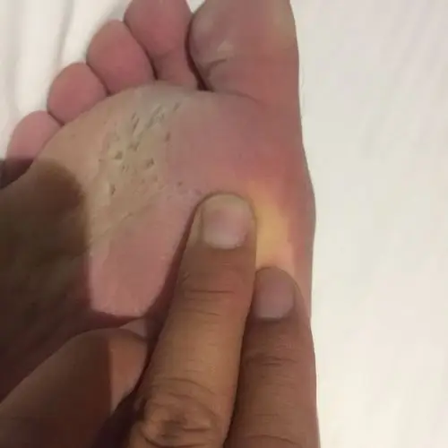 脚底有坑是怎么回事呀?