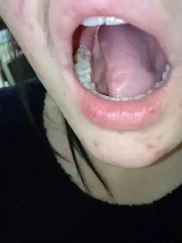 下边最后一颗牙后边牙龈肿了 特别疼 是长智齿的前兆么