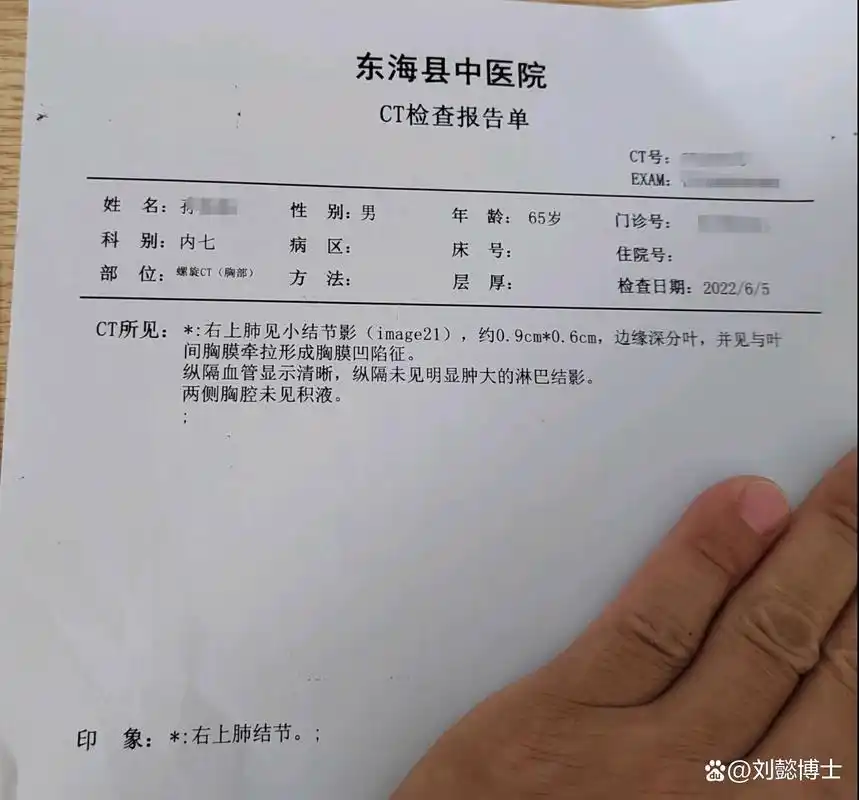 刘懿博士说肺癌(三九九〇)县医院ct有电子图像看肺结节很清楚