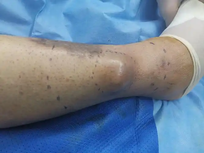 小腿恶性肿瘤规范治疗