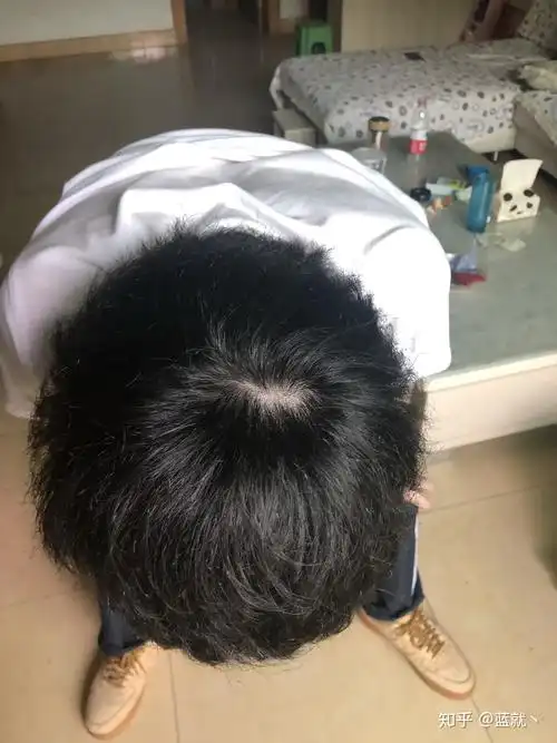 什么样子的发旋是正常的啊