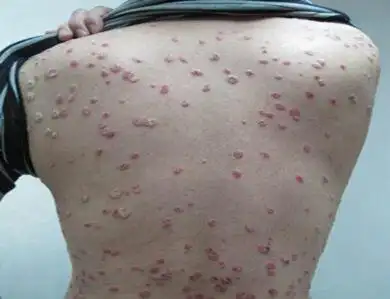 银屑症状图片初期症状