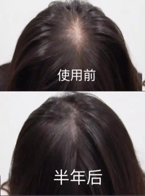 三个月秃顶星人拯救75 21世纪美少女拒绝稀疏的发量 看对比图就知道