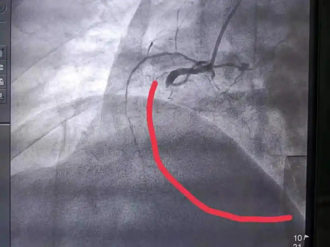 造影显示,右侧血管根部闭塞支架后血流恢复正常所以造影证实了我们的