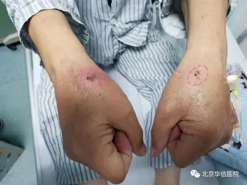 远端入径 逆向"进攻"—— 清华大学第一附属医院心脏中心成功开展复杂