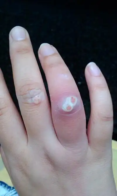 肉芽图片 (2)_有来医生