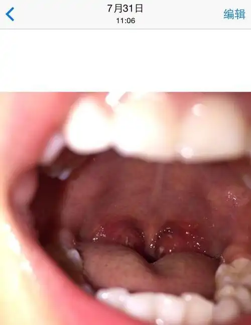 11次发烧自愈逆袭三度肿大扁桃体