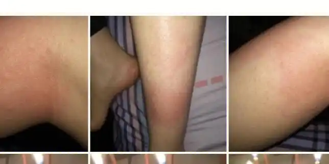 块好皮肤了 有些地方抠的结痂了还是痒,忍不住,最开始看医生说是过敏