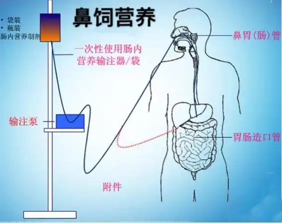 消化道肿瘤患者的术后营养支持