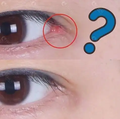 开外眼角有什么危害如何避免术后出现的回缩问题