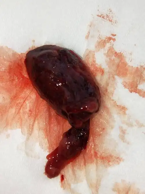 前天晚上凌晨自然流产了,昨天去医院b超检查确定是流了.