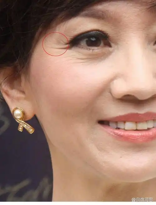 眼纹是围绕眼部出现的皱纹和细纹,常见于眼角和眼袋