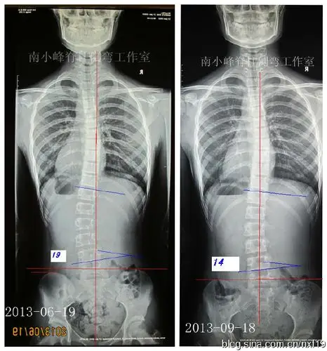 轻度脊柱侧弯要不要穿支具矫形