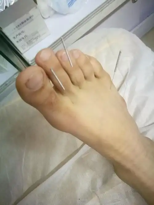 新针手足针法集锦