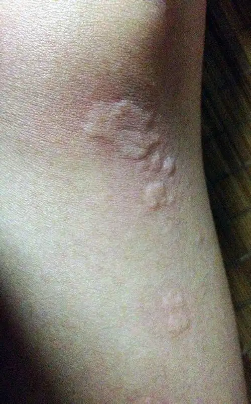 你这不是蚊子咬的包考虑为过敏性荨麻疹.