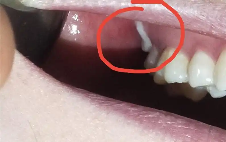 想问一下大家上面智齿横着向外长的需要拔吗