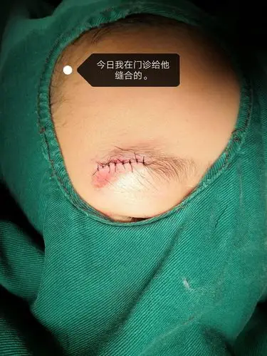 各种眼睑裂伤术前,术后对比. - 好大夫在线