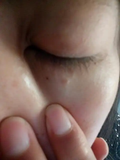 这两天眼睛下面长了两三个像脂肪粒一样的东西,而且眼睛也有点痒,严不