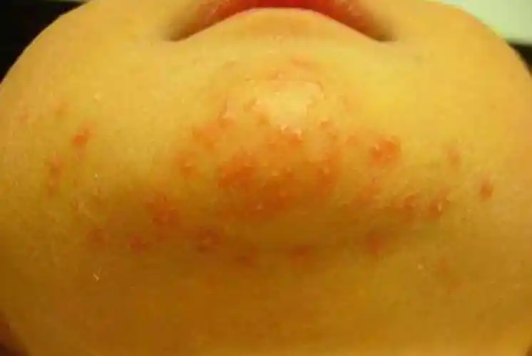 新生儿脓疱病有哪些表现及如何诊断西医治疗方法有哪些