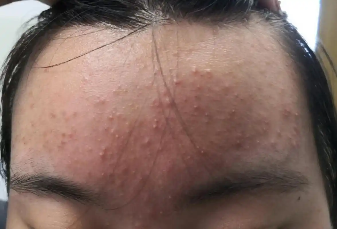 额头面颊炎症性丘疹红斑脓疱症状.是常见的痤疮发病部位和症状.