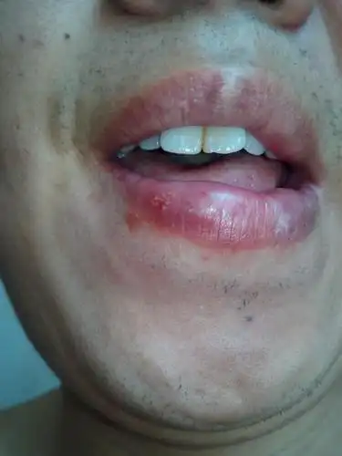 就是谁知道嘴唇上的白色米粒状是什麽东西?