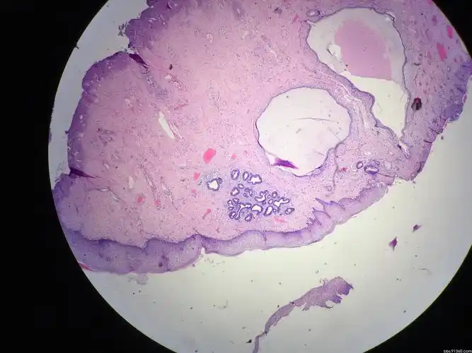 宫颈活检为鳞状上皮高度病变病例【中美加宫颈病理学交流群病例1】