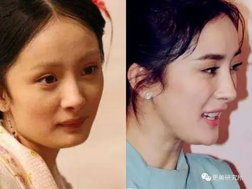 爆红30天后宋轶就去整了,怎么灵气就变了?-整容日记-杭州19楼