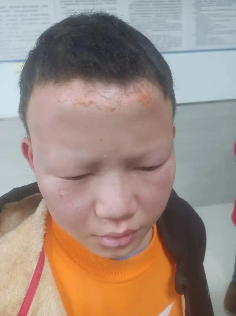 这就是不听话的代价,耍烟花把脸烧伤了,希望所有父母管好自己的 - 抖